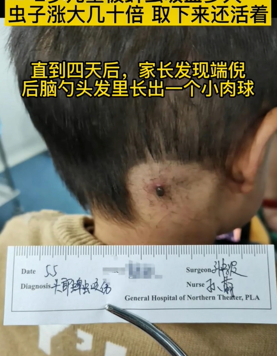 到了医院后,经医生诊查,发现是一只蜱虫钻进了孩子的头皮里,并且虫子