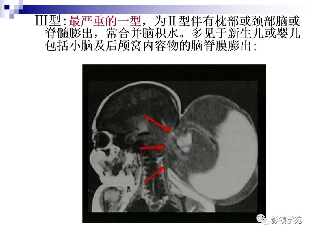 小脑扁桃体下疝畸形概述