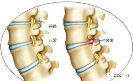 腰椎间盘突出手术不取钢钉会影响怀孕吗？