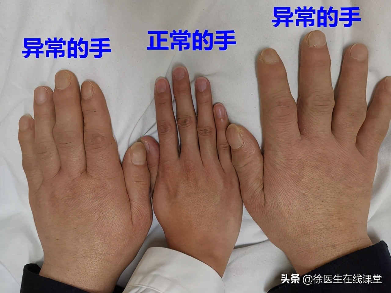 血糖高怎么办？医生教你三招，守护健康稳定血糖