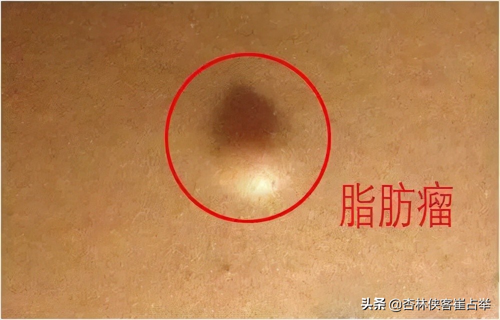 身上有脂肪瘤怎么办？医生告诉你不要担心，用这两味药可以消掉