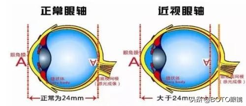 1000多度近视能快跑吗（高度近视运动需注意的事项）-华海博客