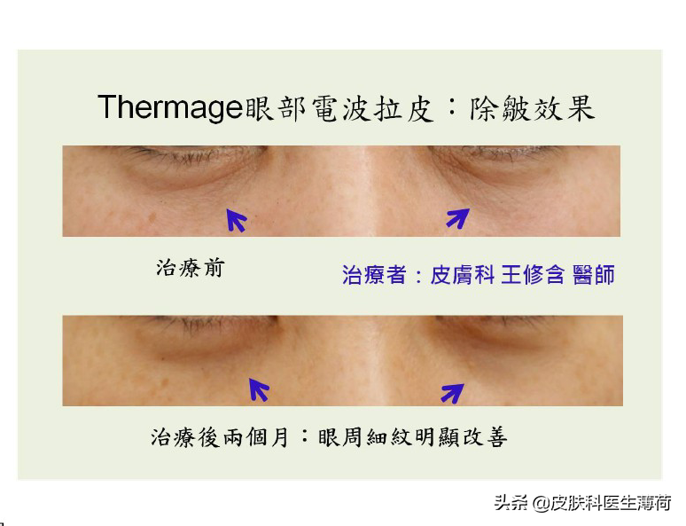 黑眼圈怎么形成的？如何彻底的去黑眼圈？|皮肤科医生良心出品