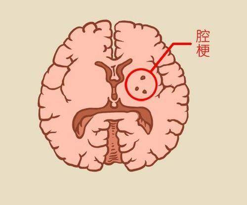 发现腔梗，就要吃阿司匹林吗？医生提醒：做到这5件事更重要