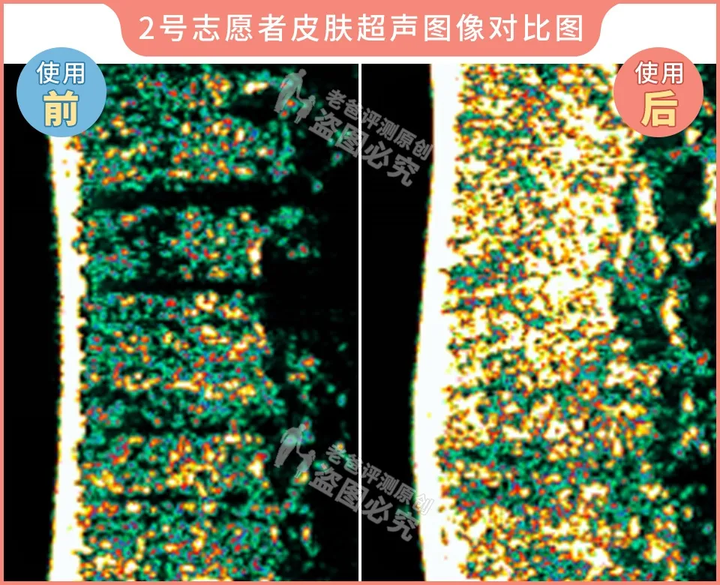 网红家用美容仪真的有效吗？2个多月的跟踪实测结果来了