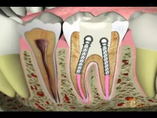 牙疼后为什么医生建议你根管治疗而不是补牙