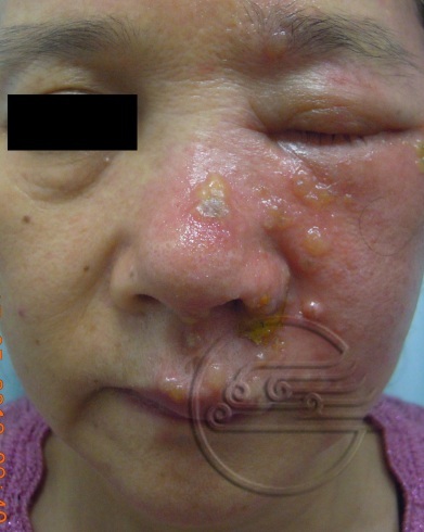 儿童传染性软疣怎么处理比较安全