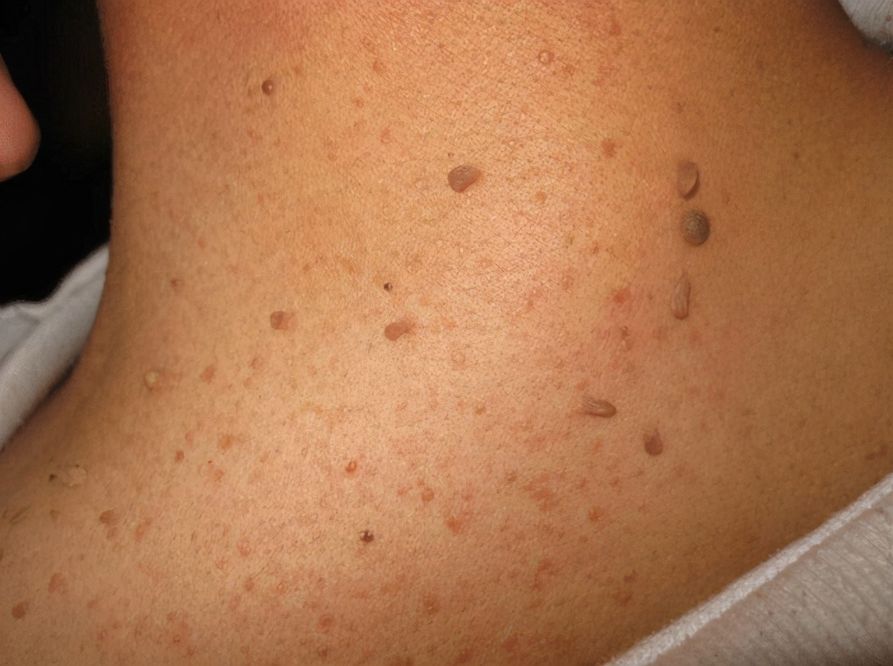 皮赘物皮赘物是皮肤出现的一些增生组织,其实是一种正常的皮肤问题