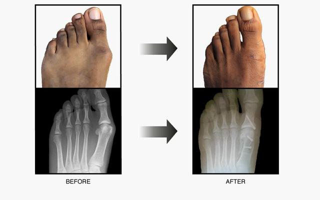 大脚拐,大脚趾内侧疼痛,要警惕:拇(趾)外翻,拇囊炎