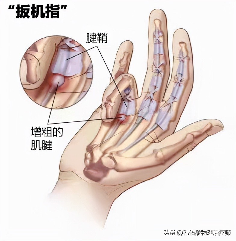 中老年女性常手指疼痛、肿胀，是腱鞘炎吗？该怎么办？告知您