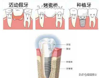 种植牙、烤瓷牙和镶牙哪个好？一起来说说牙齿那些事