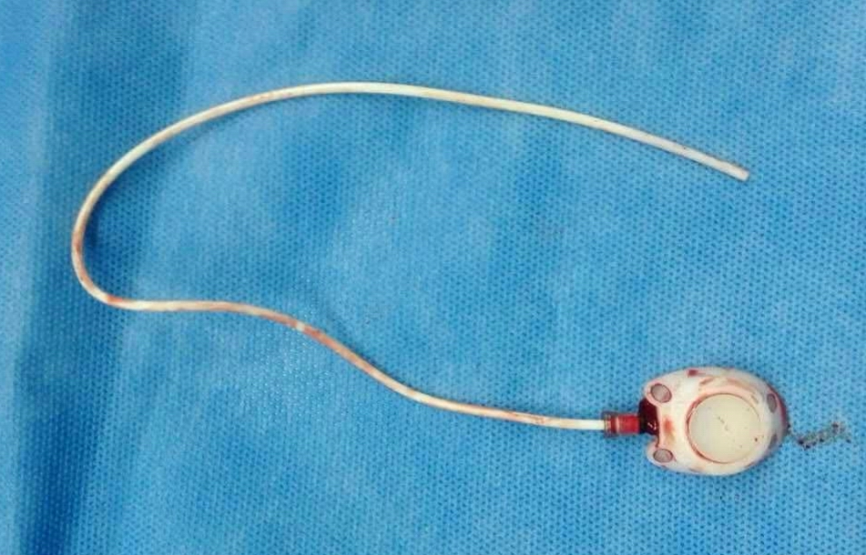 输液港是什么东西?避免手足瘀青,家长心痛,护士叫苦的逆天妙招