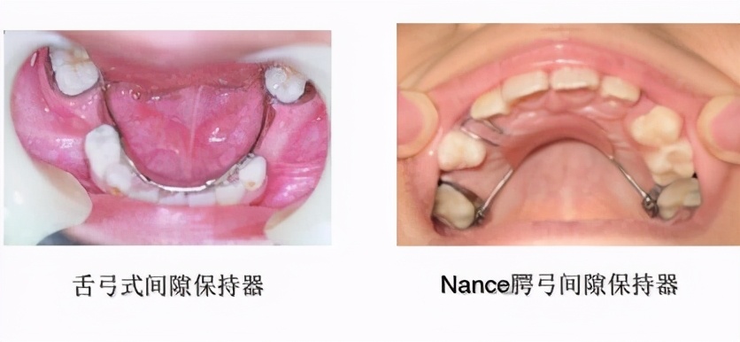 固定式间隙保持器:粘固于基牙上不需自行摘戴,患儿的依从性好,便于