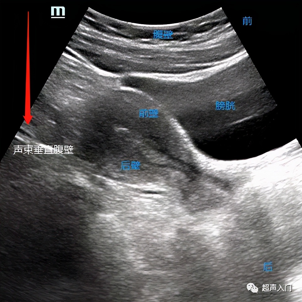 膀胱超声解剖图及解释图片