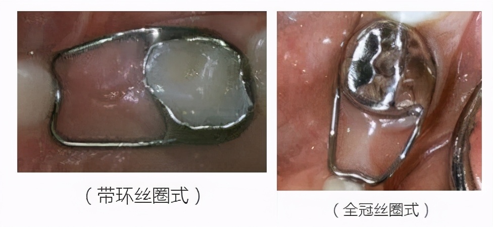 乳牙早失后，医生为什么建议做「间隙保持器」？是不是在坑钱？