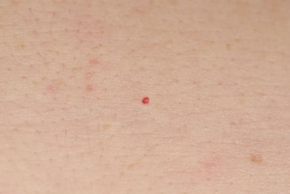 胳膊上有小红点 艾滋初期症状小红点图片-百科叔叔