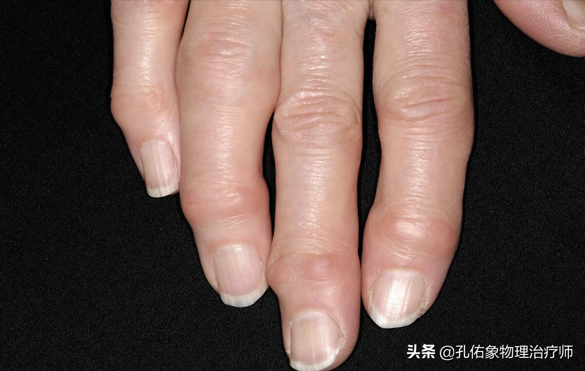 上下楼梯,下蹲困难,到医院就诊,经常被告知是膝关节骨性关节炎