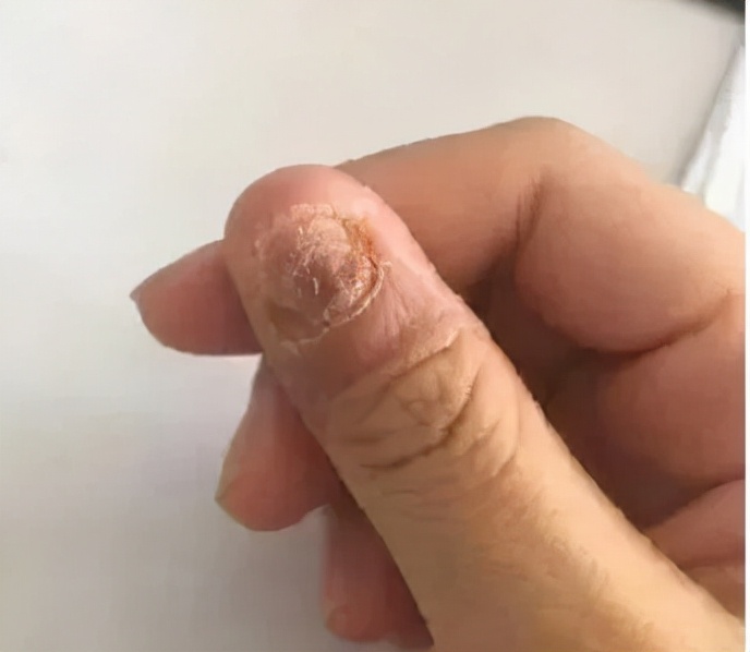 指甲长这样,是癌症的信号?别不信!