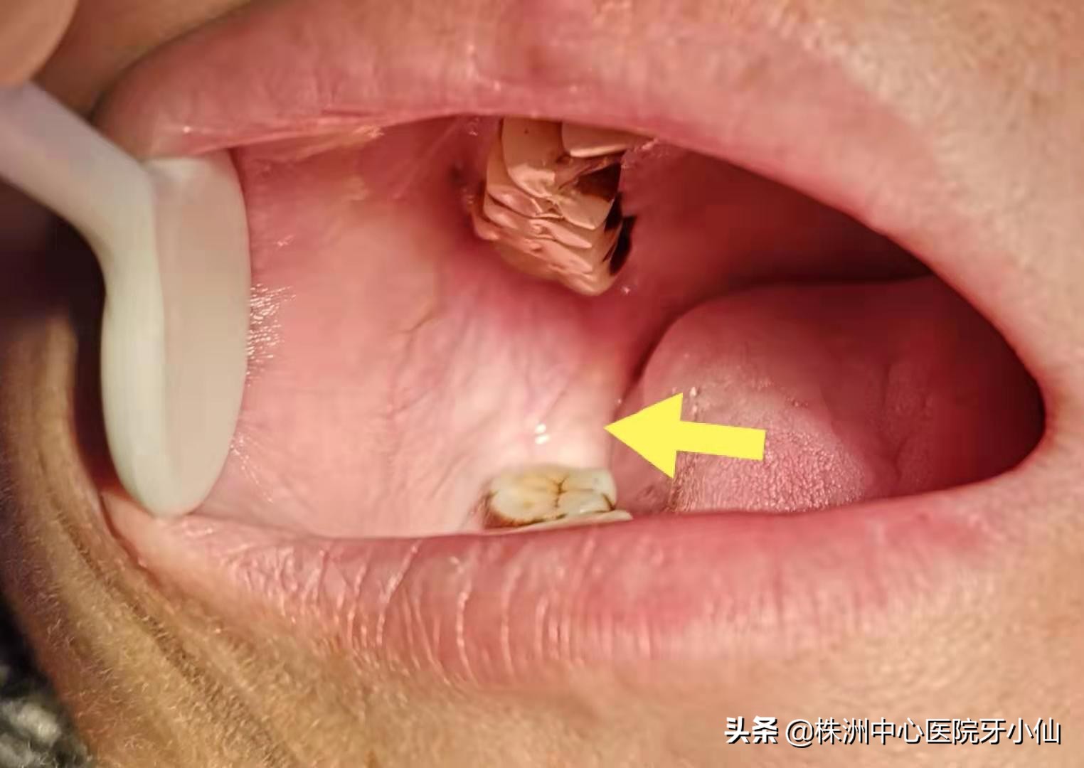 口腔真菌感染症状图片