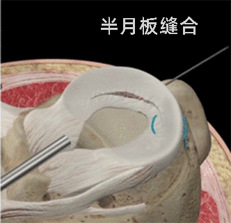 有些人年纪轻轻，但「半月板」已经撑不住了……