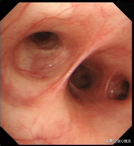 什么是气管镜检查？检查中的感受怎样？看完这篇文章你就知道了