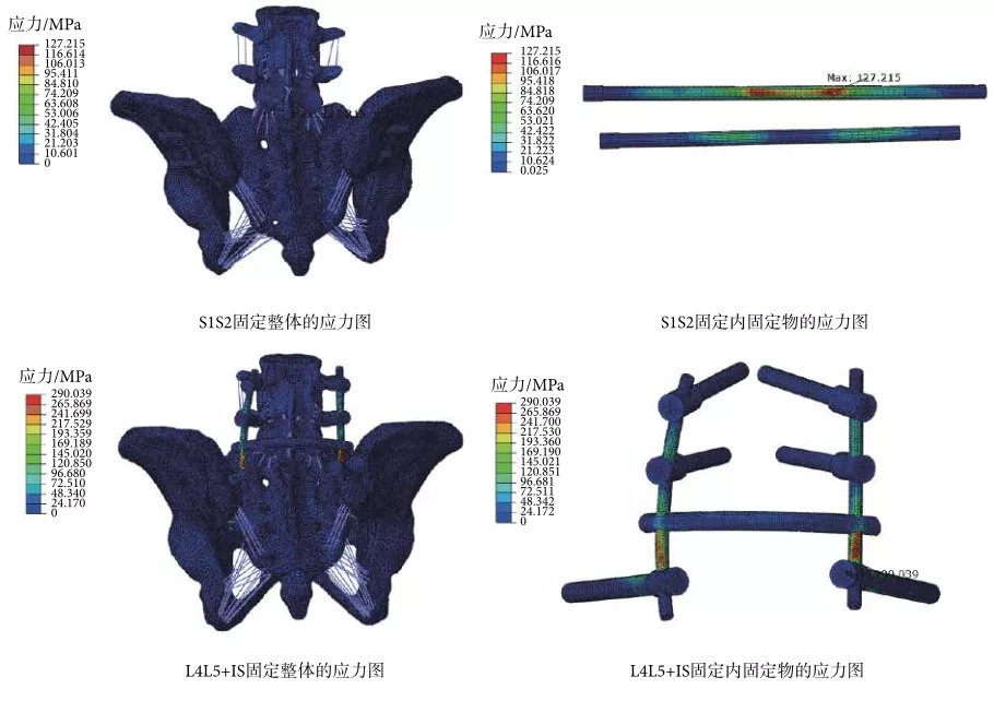 U型骶骨骨折固定的有限元分析
