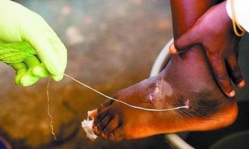 人得了铁线虫病图片(这种寄生虫通过喝水进入消化道) - 赤虎壹号