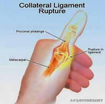 打排球戳到大拇指了会不会伤到筋(手指打篮球挫伤了，半年不恢复，还肿着，听听医生给您的治疗建议)