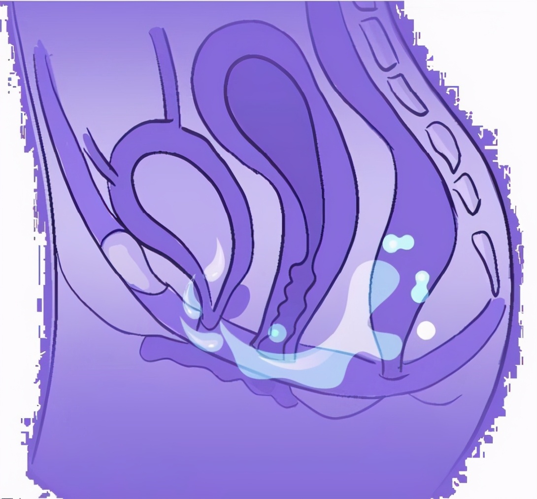 有盆腔积液就是盆腔炎吗?