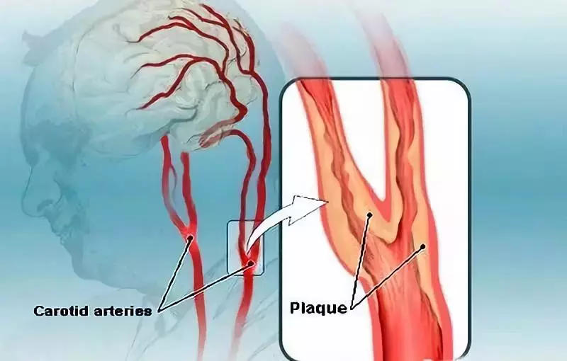 颈动脉，人体最怕堵的血管！50%中风都跟它有关