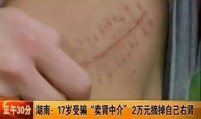 8年过去了，当年为买苹果手机不惜卖肾的男孩，如今怎么样了