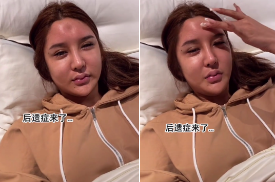 她一摸发现自己额头出"坑"了,还表示自己整容越整越低端.