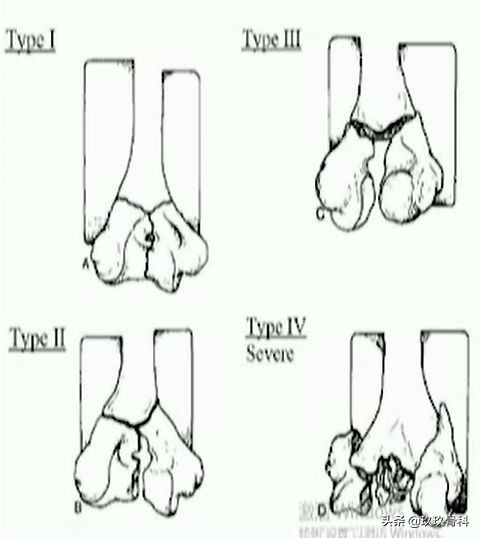 肱骨远端骨折的分型和治疗原则