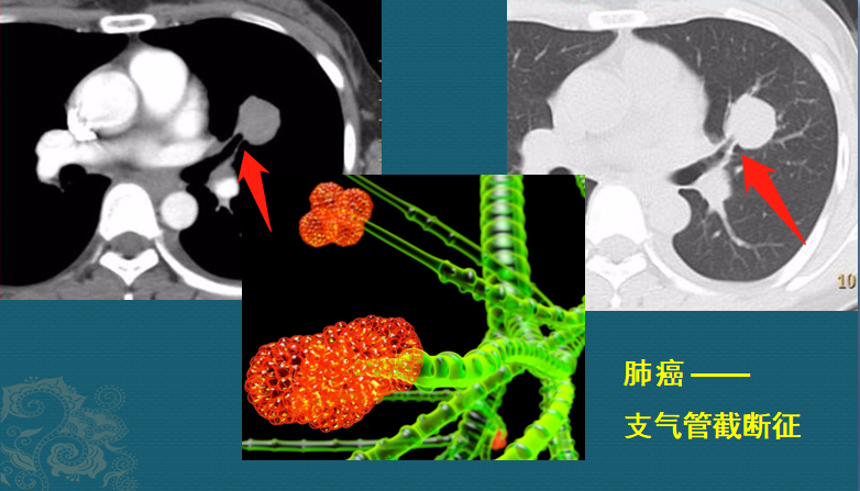 从CT片上看肺癌结节，有4个常见表现，医生教你入门学CT
