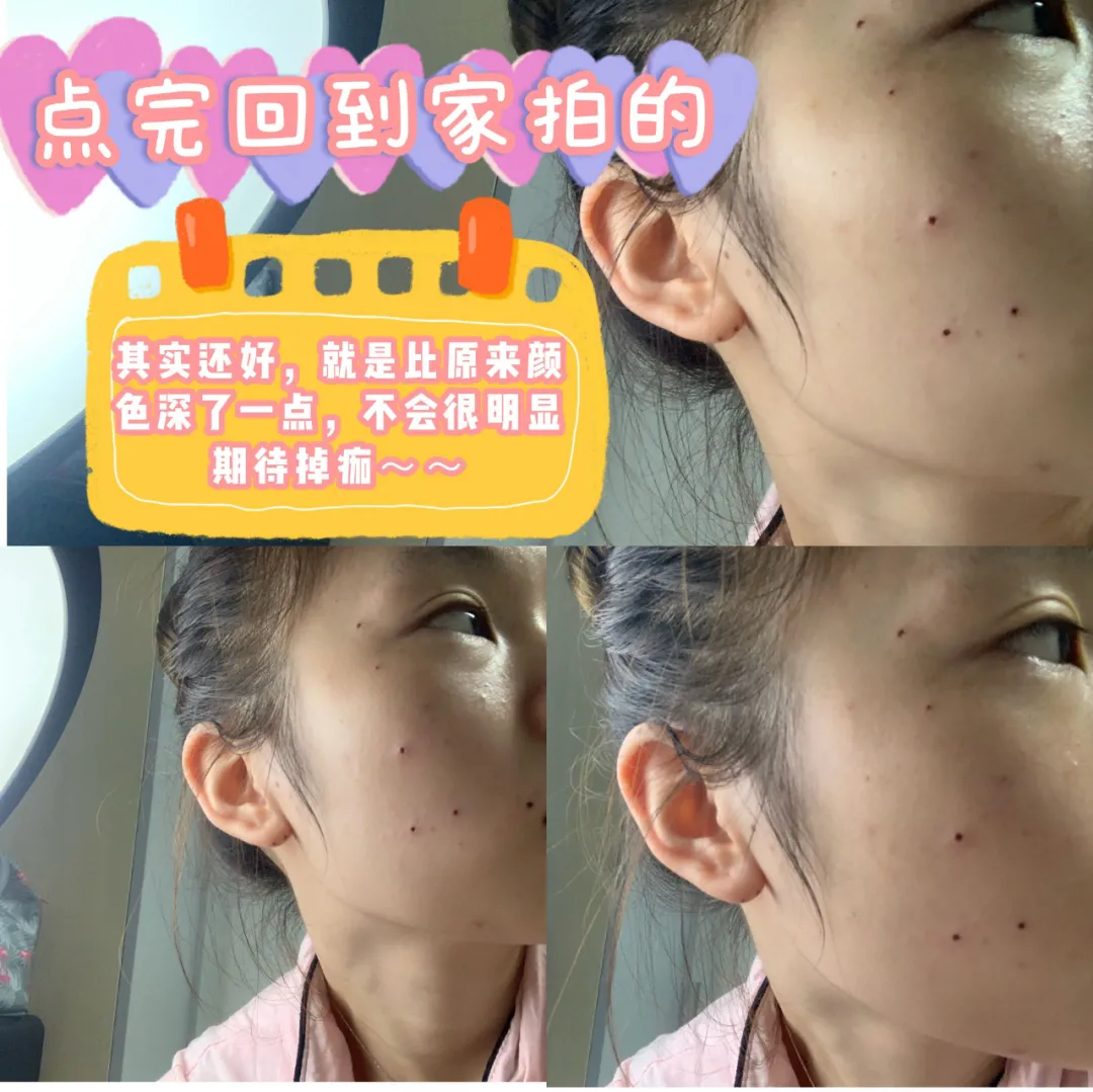 痣多星人的药水点痣分享,点完不忌口,离变美又近了一步