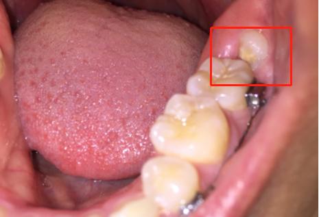 智齿冠周炎图片 冠周炎图片-起航号
