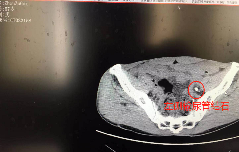 突发腰痛别小视！湖北大叔突感腰痛经查结石严重致肾功能受损