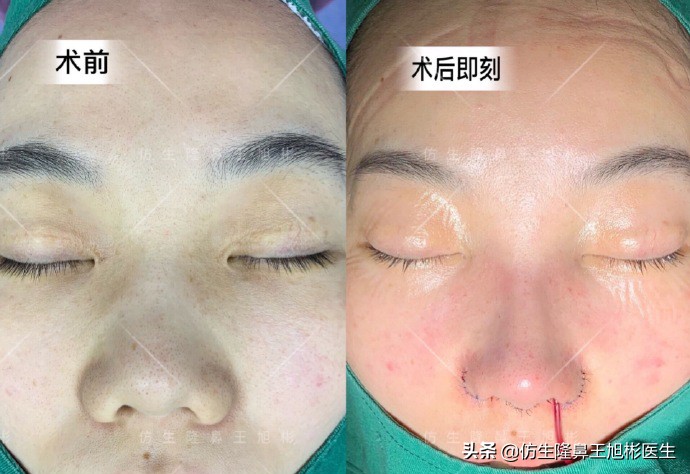 如何定义短鼻，短鼻延长后的改变有多大？