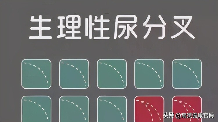 's生理性尿分叉往往不伴随整个排尿过程,常发生在排尿结束或