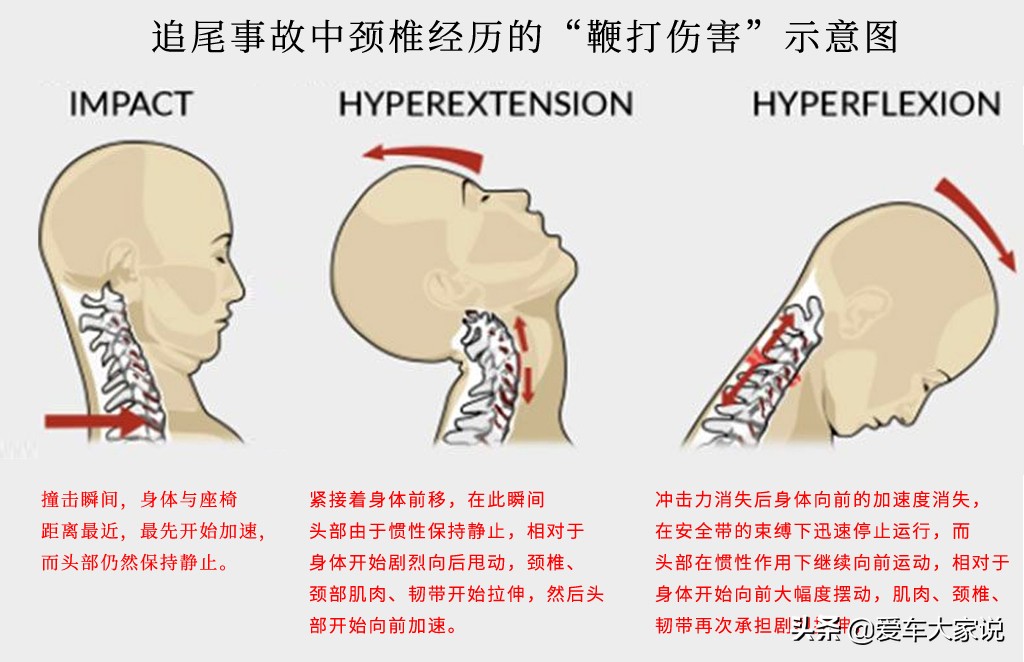 开车被追尾，别随便私了，当心“鞭打伤害”
