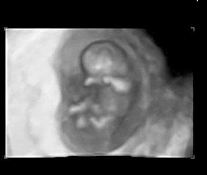 三个月胎儿真实图片(怀孕前三个月宝宝啥样，每周B超图告诉你胎儿发育情况，天然可爱)