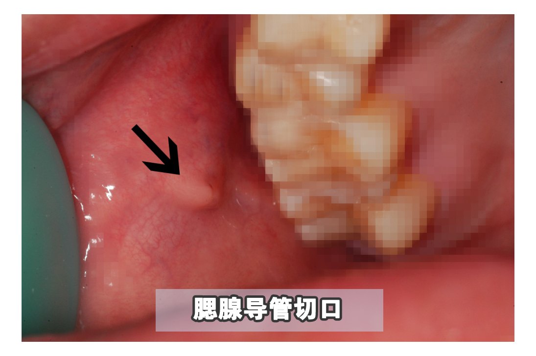 嘴里长了可怕的“肉揪”，真的不是口腔癌吗？