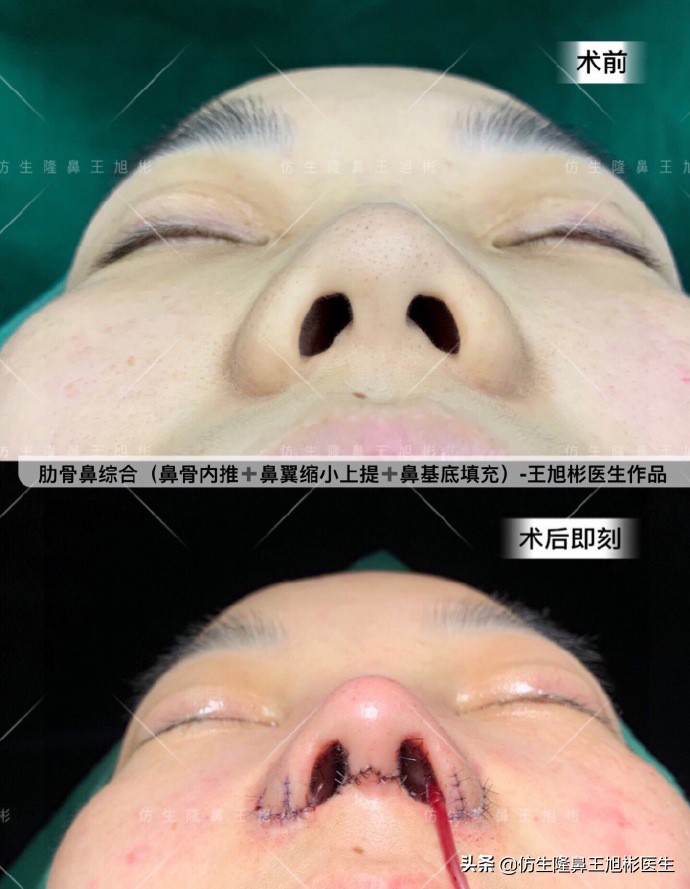 如何定义短鼻，短鼻延长后的改变有多大？