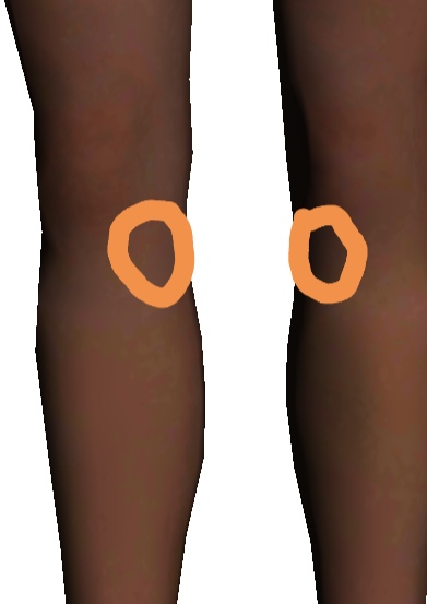 小腿内侧疼怎样康复?