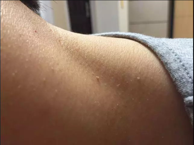 颈部长小肉球，抠掉会怎么样，如何处理，医生给你说明白了