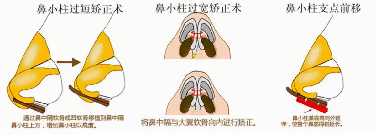 常见的鼻小柱几种问题与改善方法