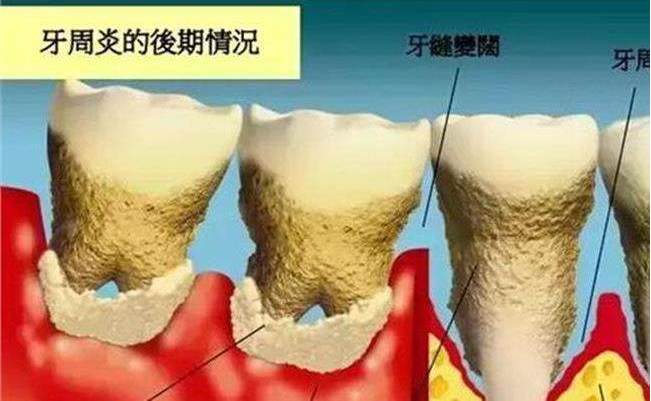牙龈萎缩严重,牙齿逐渐松动难以逆转,提早警惕对症下药才是王道