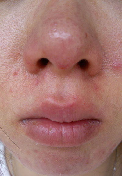 玫瑰痤疮怎么引起的(玫瑰痤疮是什么?