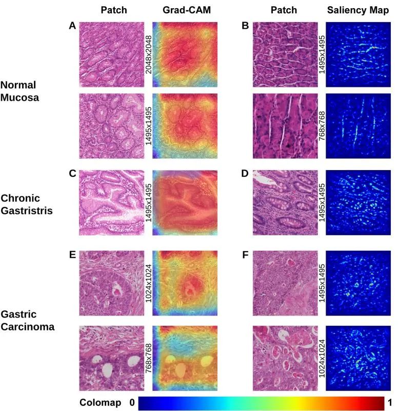 于颖彦教授：利用深度学习模型预测胃黏膜良恶性病变新进展