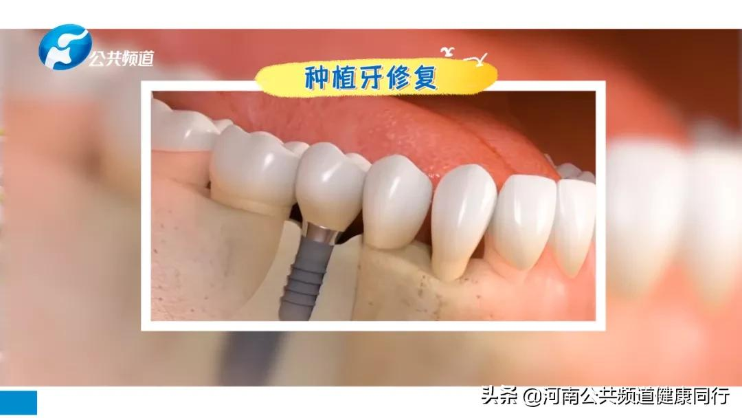 关注口腔 爱在植得 | 高昂:牙齿缺失影响全身健康,特别是老年人,不可忽视